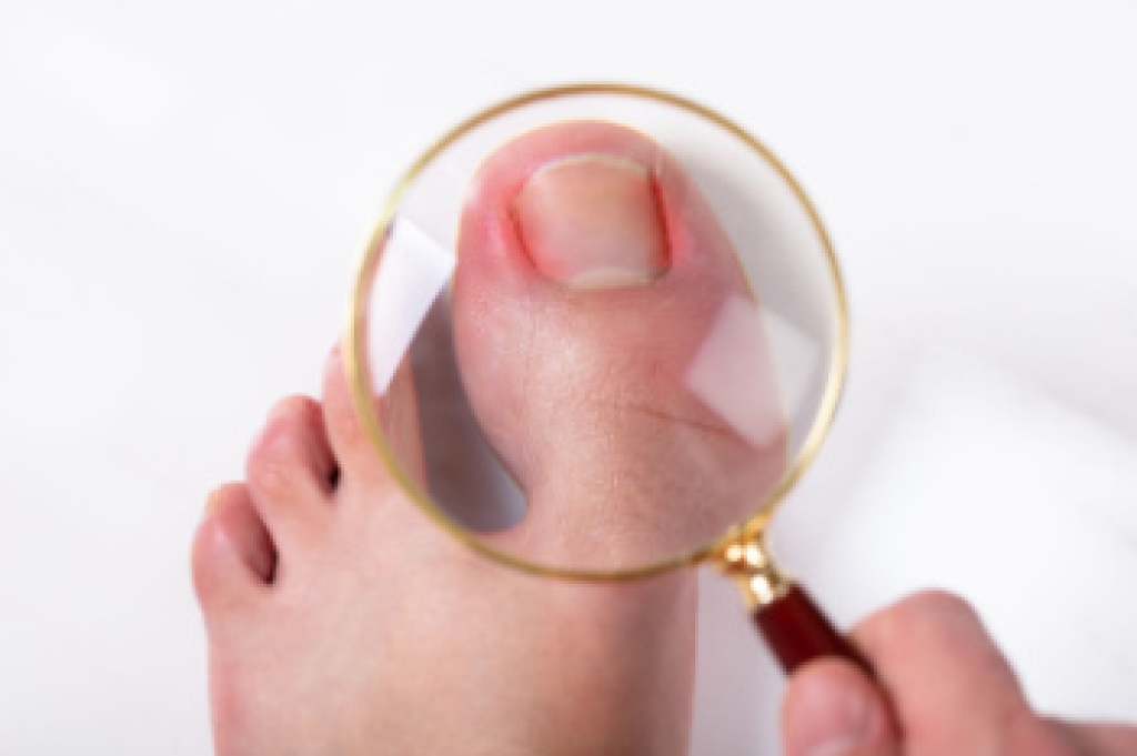 When to Seek Care for Ingrown Toenails