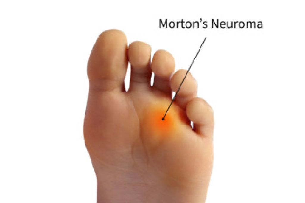 A Podiatrist's Role in Treating Morton’s Neuroma