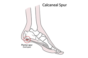 Do I Have a Heel Spur?