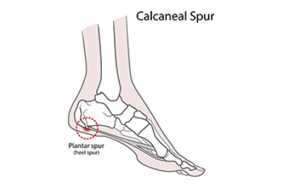Do I Have a Heel Spur?