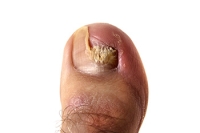 Definition and Risk Factors for Toenail Fungus