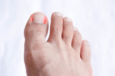 Categories of Ingrown Toenails