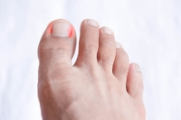 Categories of Ingrown Toenails