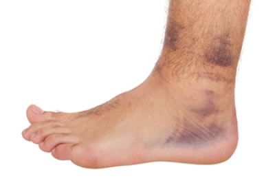 Treating a Sprained Ankle