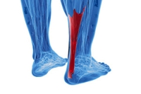 Diagnosis and Treatment of a Torn Achilles Tendon