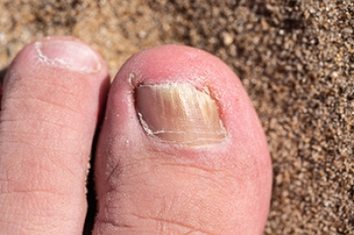 Managing Thick Toenails Caused by Fungal Infections