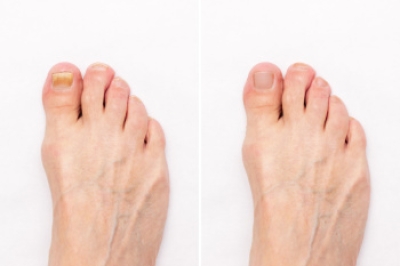 Definition and Risk Factors of Onychomycosis