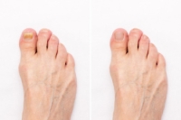 Definition and Risk Factors of Onychomycosis